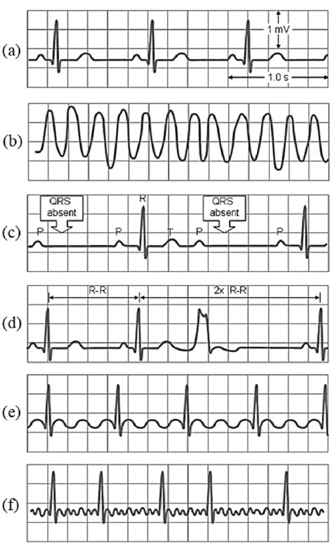 ekg readings abnormal